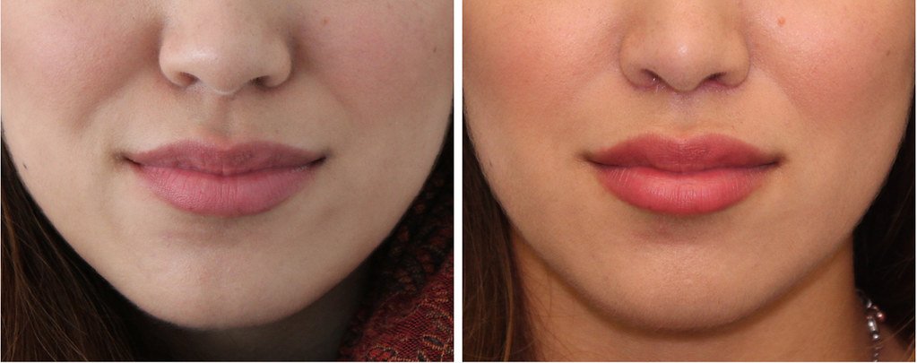 Lip Lift Before - After